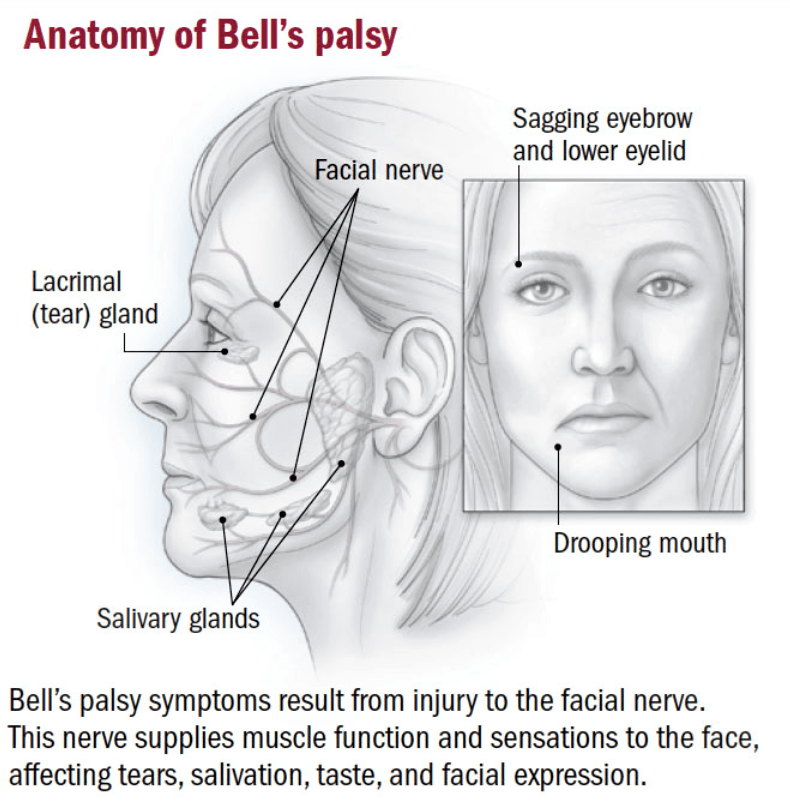 symptoms of facial paralysis